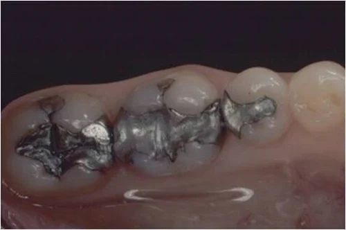 Old metal dental fillings and worn tooth restorations