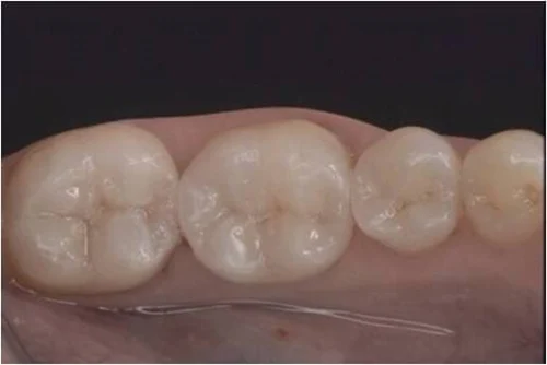 Tooth-colored dental fillings replacing old metal restorations
